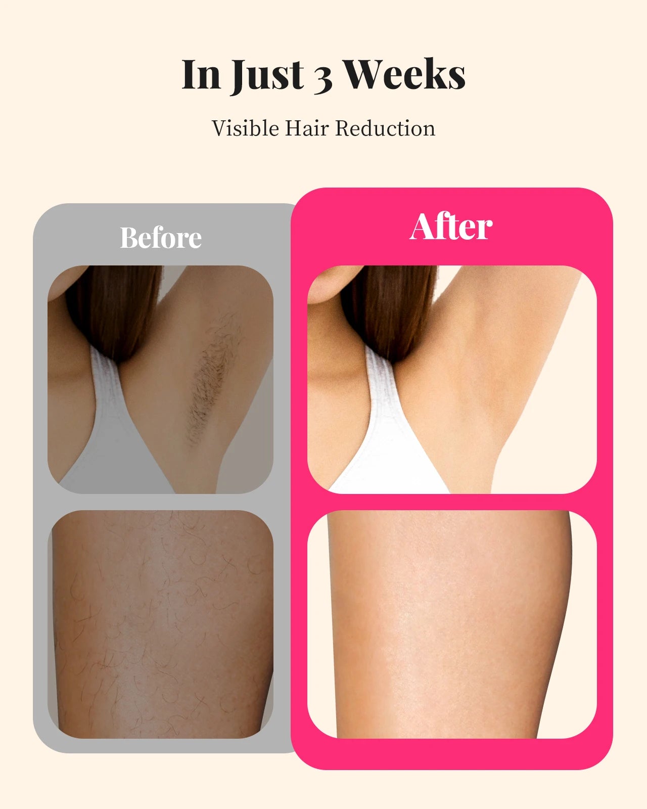 IPL Permanent Hair Removal Device